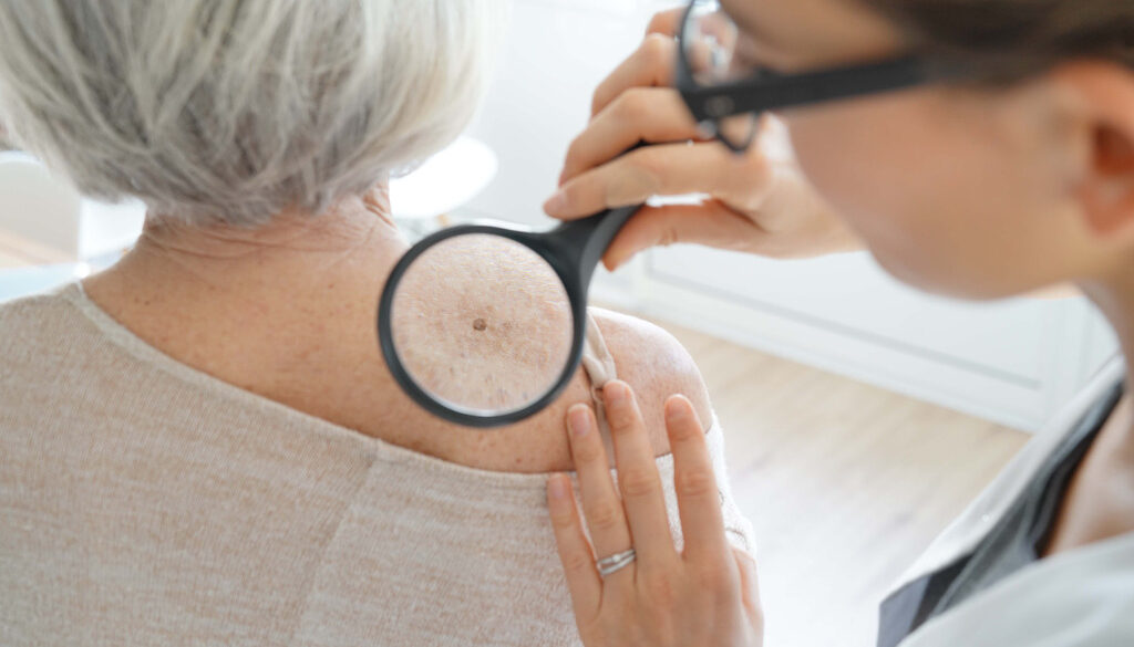 An Older Woman Getting a Skin Cancer Check From a Doctor