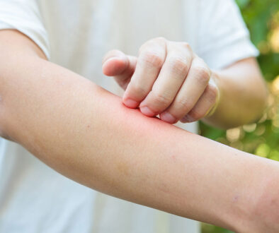 Closeup Of A Man Outdoors Scratching A Red Spot On His Arm From An Insect Sting Allergy