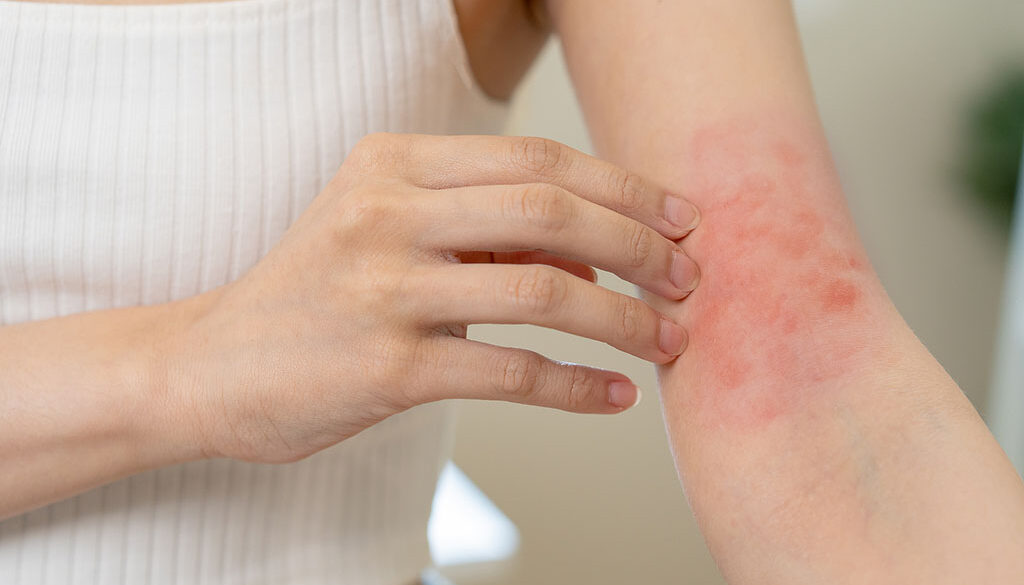 Closeup Of A Woman Scratching A Red Mark On Her Forearm Hives Caused By Allergies