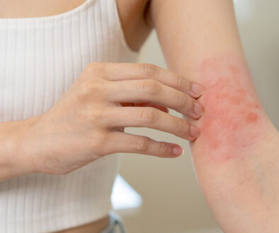 Closeup Of A Woman Scratching A Red Mark On Her Forearm Hives Caused By Allergies